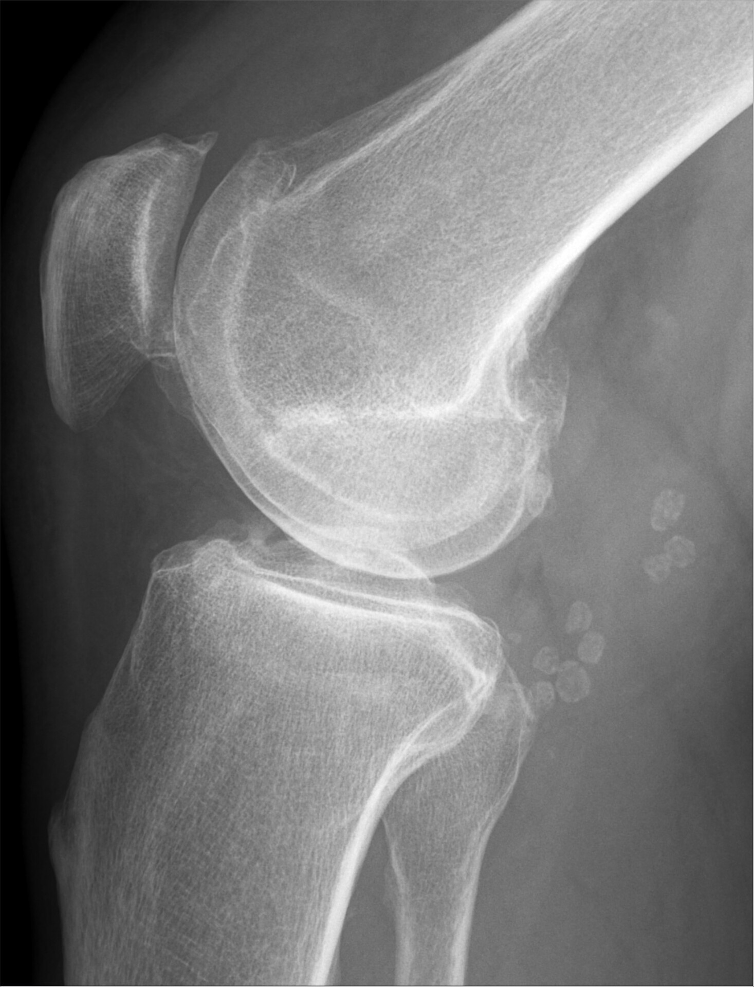 Baker's Cyst - Diagnosis - StoryMD