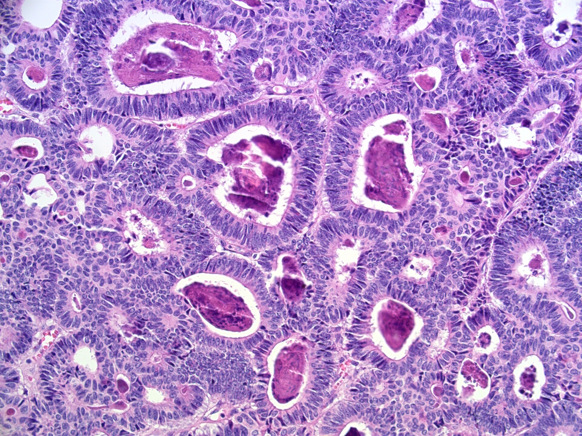 Sertoli-Leydig Cell Tumors - StoryMD