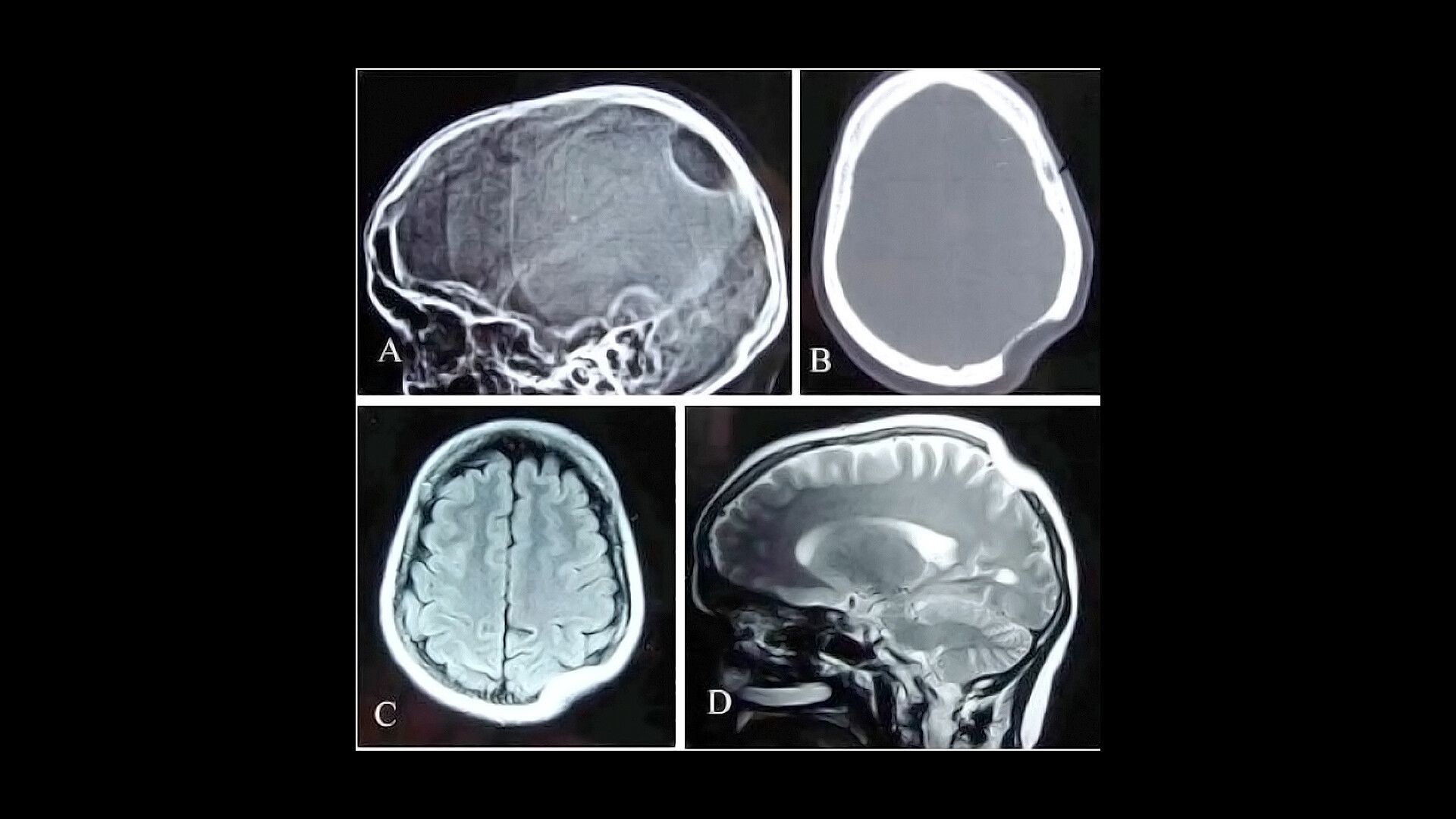 Gorham's Disease - StoryMD