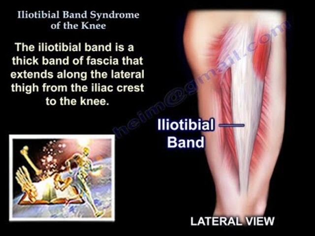Iliotibial Band Syndrome - StoryMD