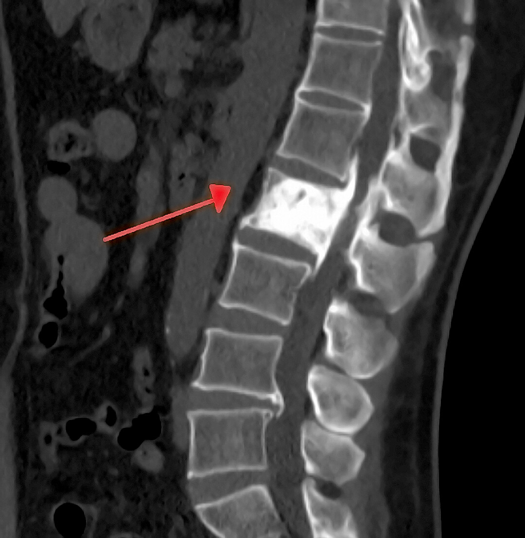 Information for People Newly Diagnosed With Paget’s Disease of Bone