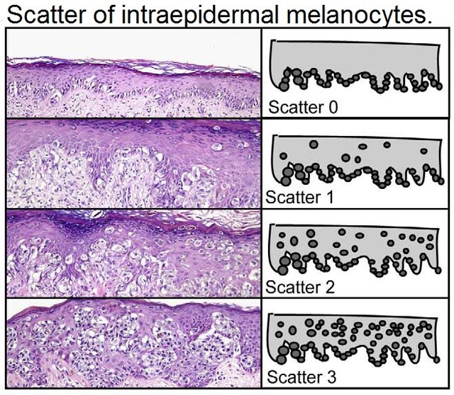 melenic vs melanotic Melanoma vs Benign Melanocytic Nevus main image 0