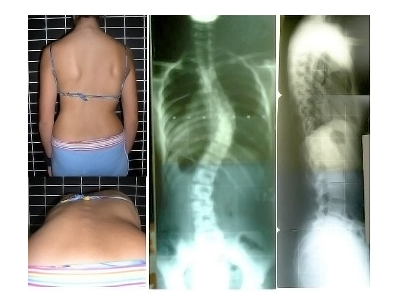 ما هو اعوجاج العمود الفقري عند الأطفال؟