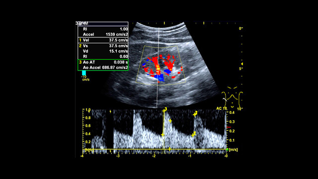 Doppler echocardiography - Wikipedia