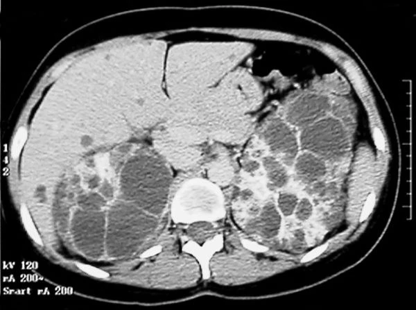 Can A Ct Scan Detect Polycystic Kidney Disease