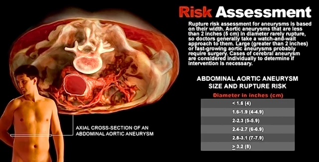 Do You Have An Aortic Aneurysm The Case For Aortic Screening Abdominal