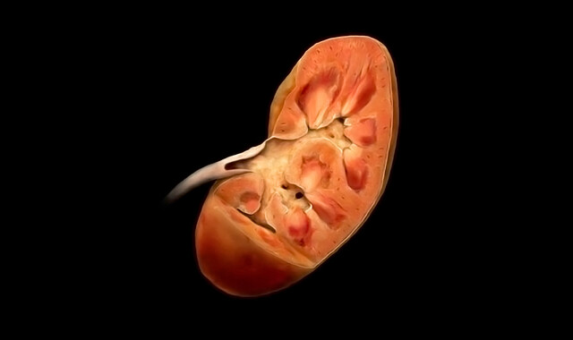 Nephrocalcinosis - StoryMD