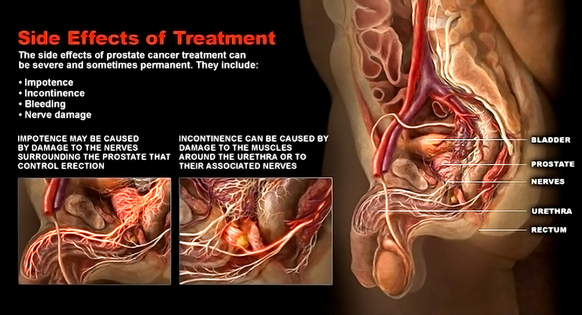 What Are the Side Effects of Treatments for Prostate Problems