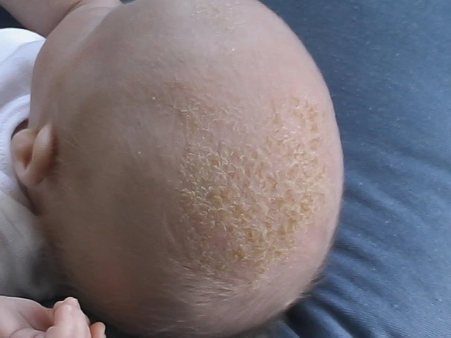 Cradle cap sales wash hair everyday