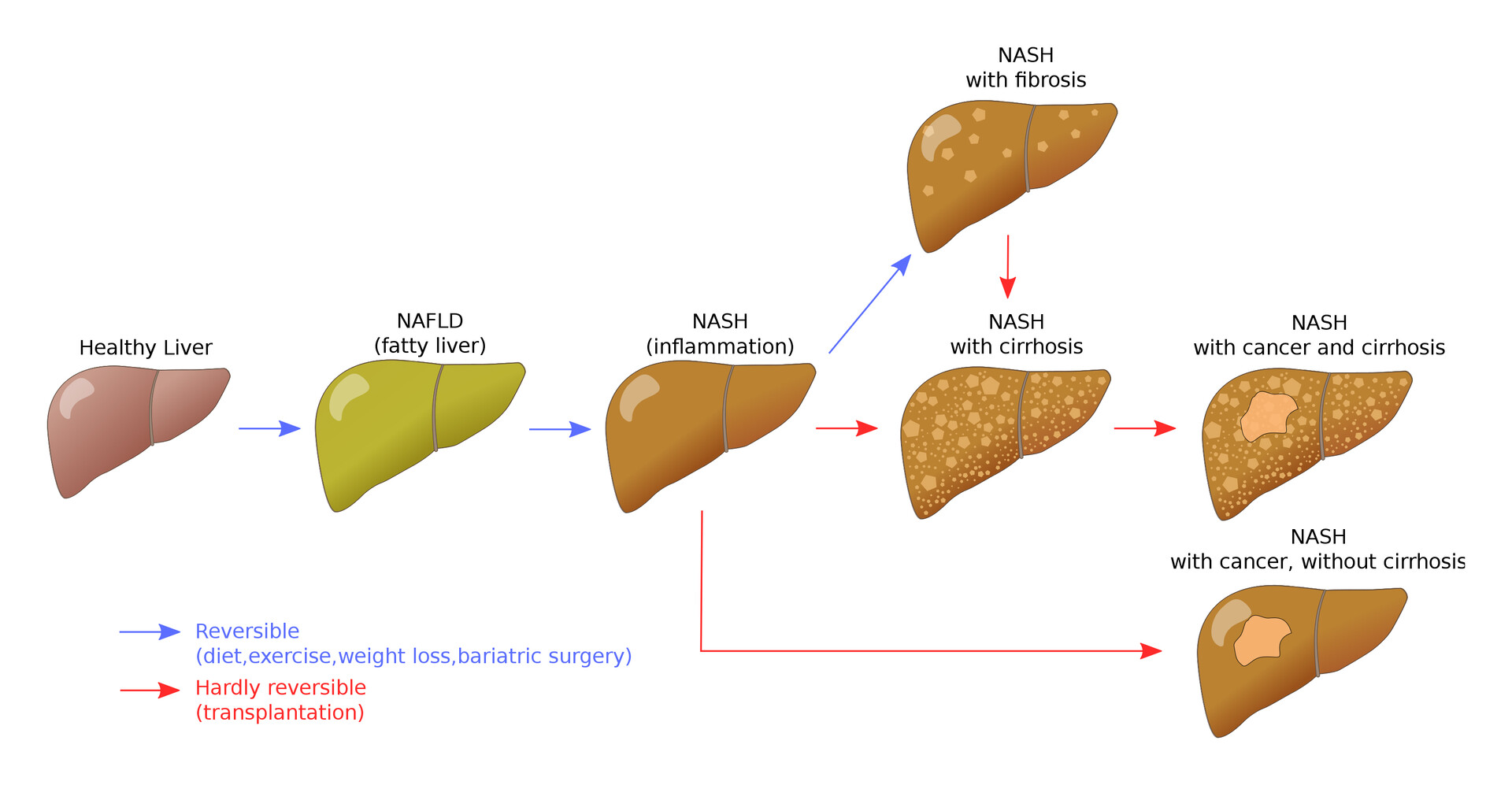 Non alcoholic liver disease. Meld (model for end-Stage Liver disease).