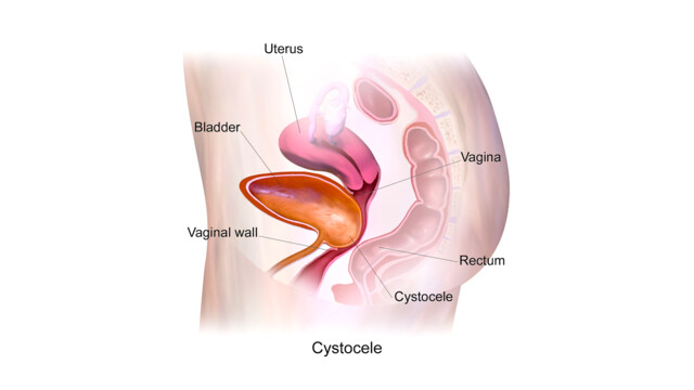 Pelvic Floor Disorders - StoryMD