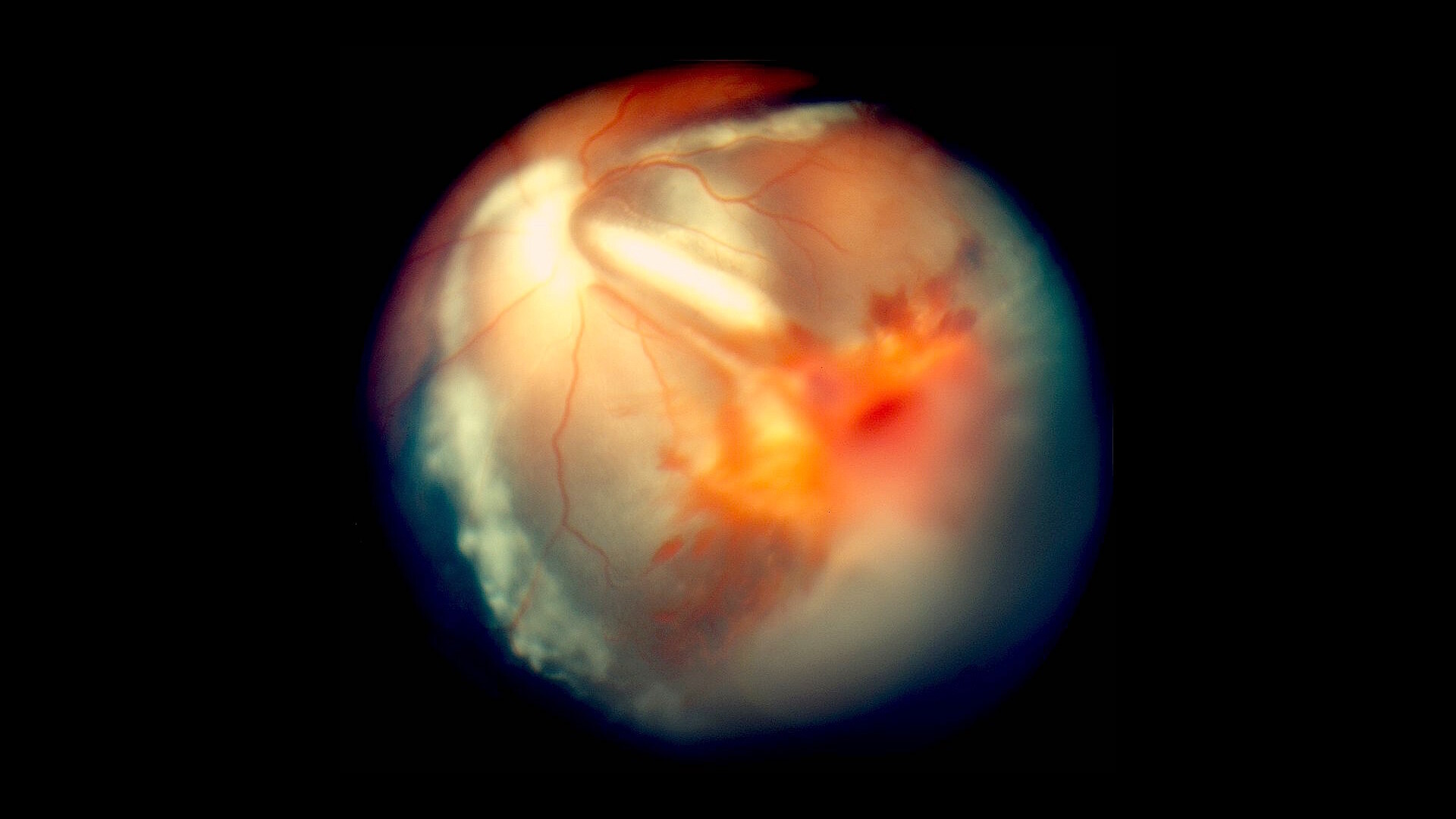 Vitreous Detachment StoryMD