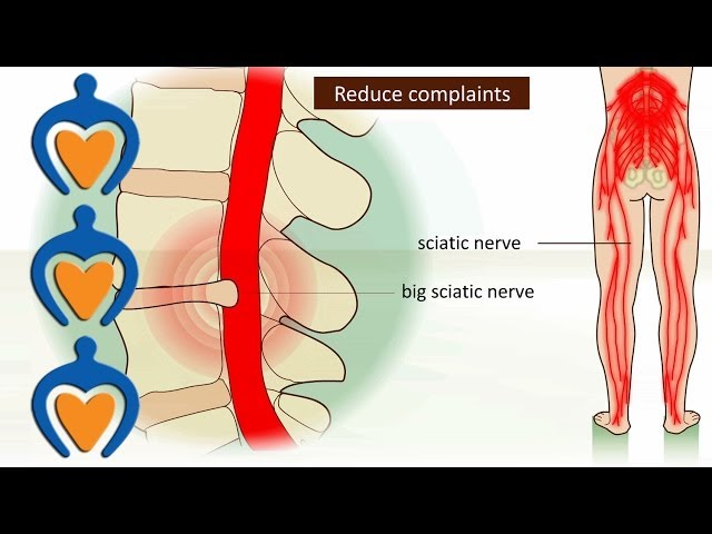 Sciatica - StoryMD