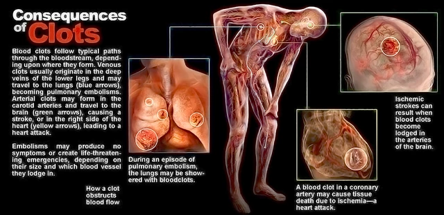 Pulmonary Embolism (Blood Clots in the Lung): Causes, Symptoms