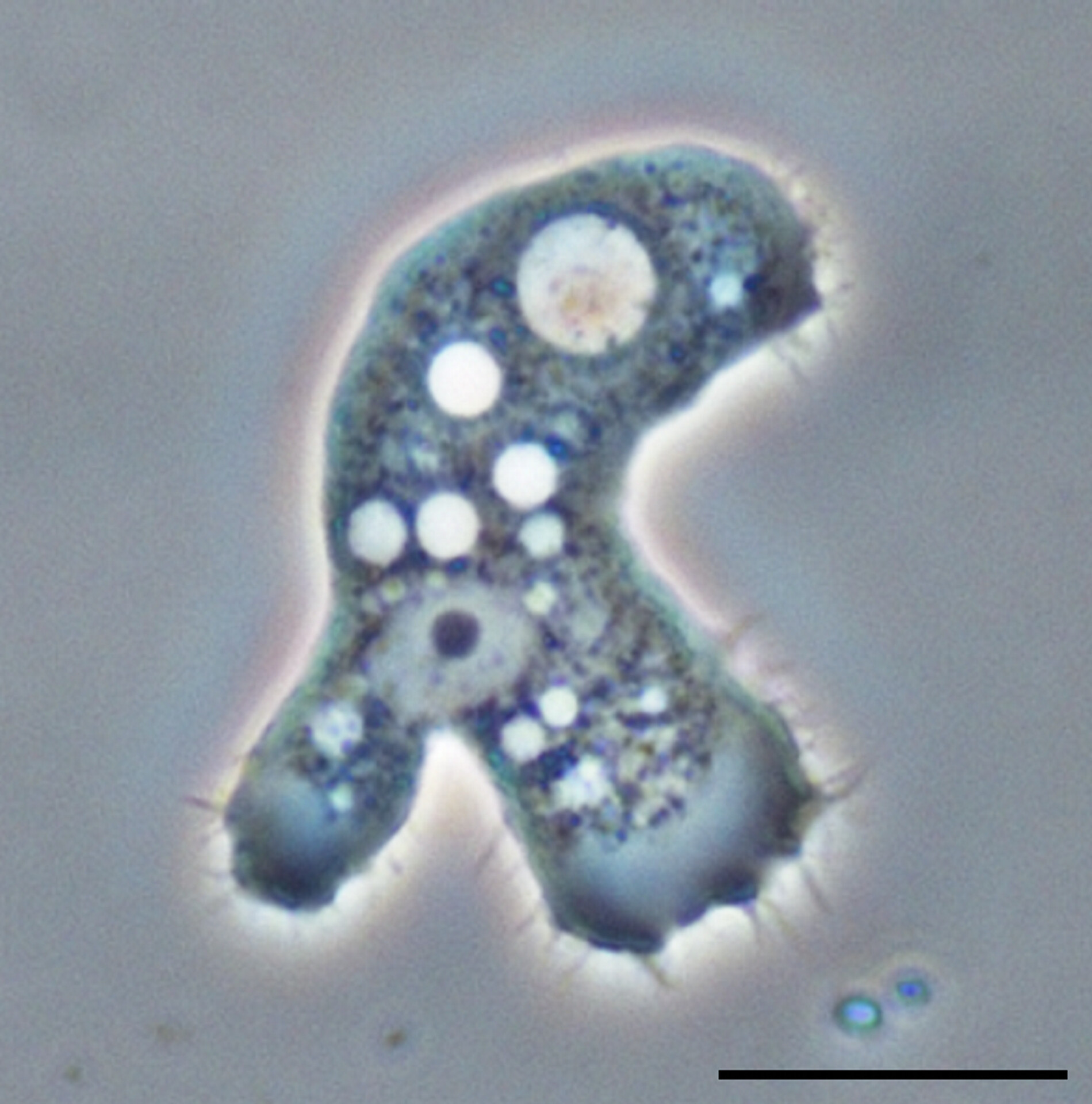 What Is Acanthamoeba Infection Storymd 6319