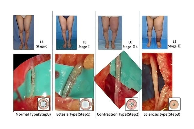 A new severity classification of lower limb secondary lymphedema