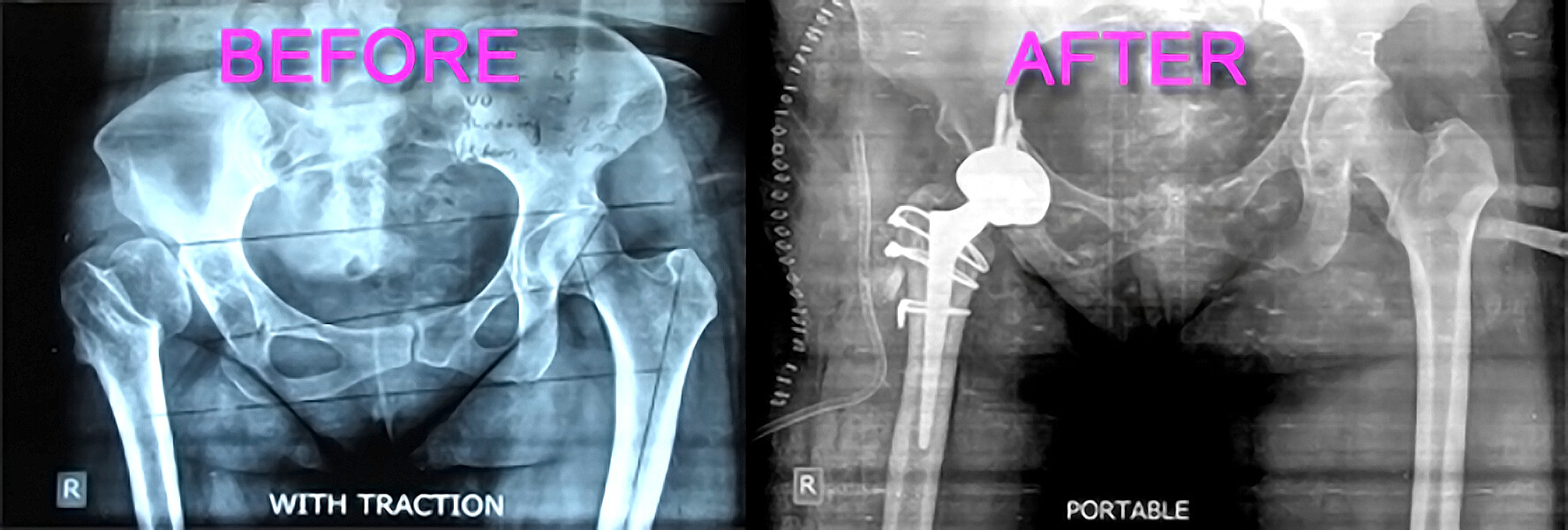 Effectiveness of Metal-On-Metal Hip Implants - StoryMD