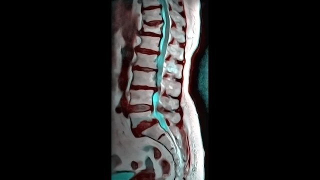 Vertebral Compression Fractures - Diagnosis - StoryMD