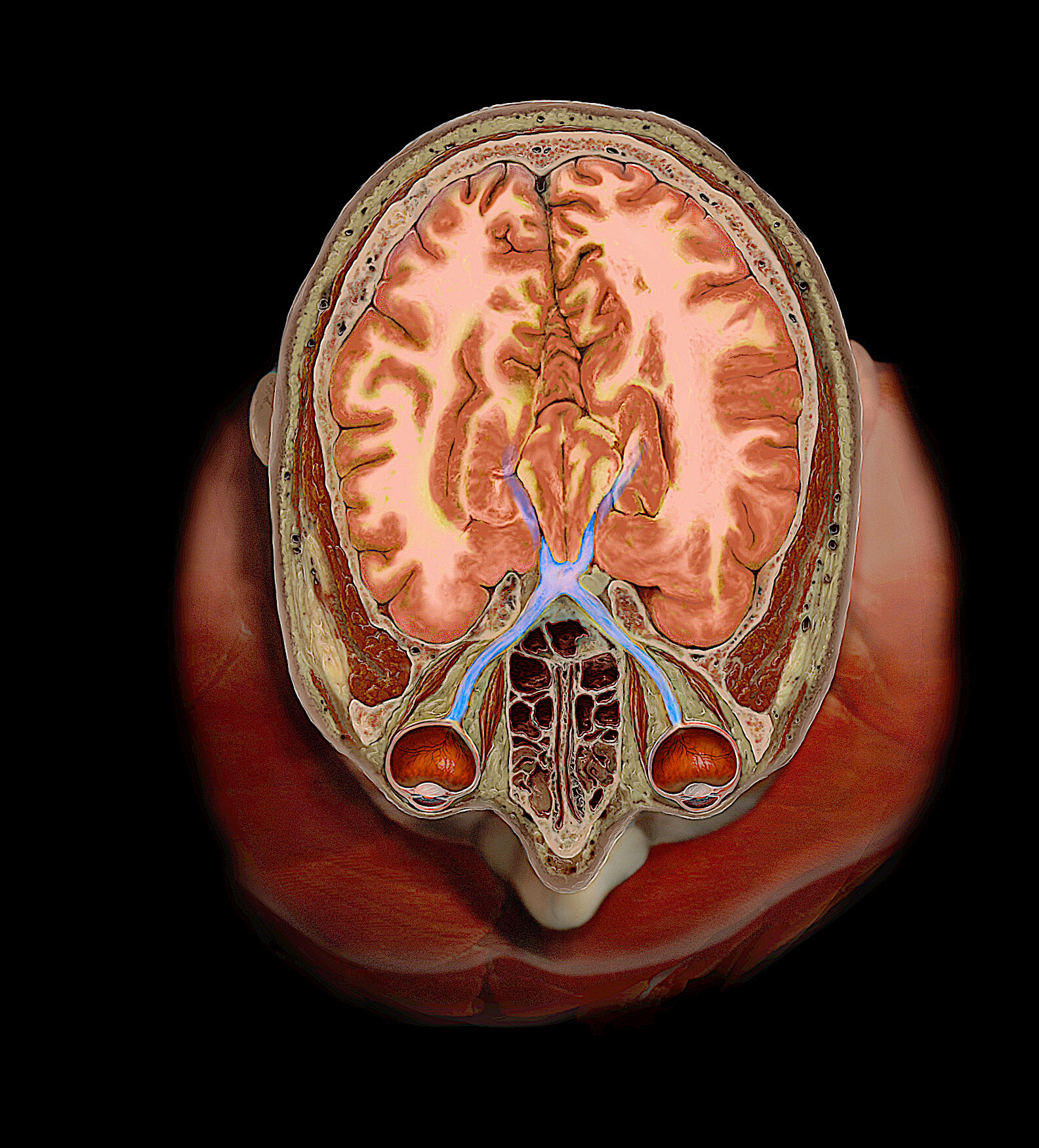 Optic Nerve and Tract StoryMD