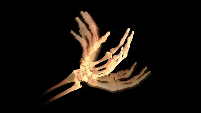 Repetitive Motion Disorder Tardive Dyskinesia (TD): What It Is,