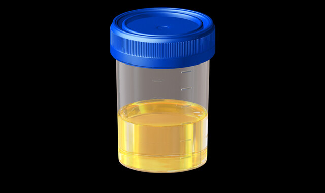 Mucus In Urine Test Why Is It Done And What The Results Mean Storymd 5314