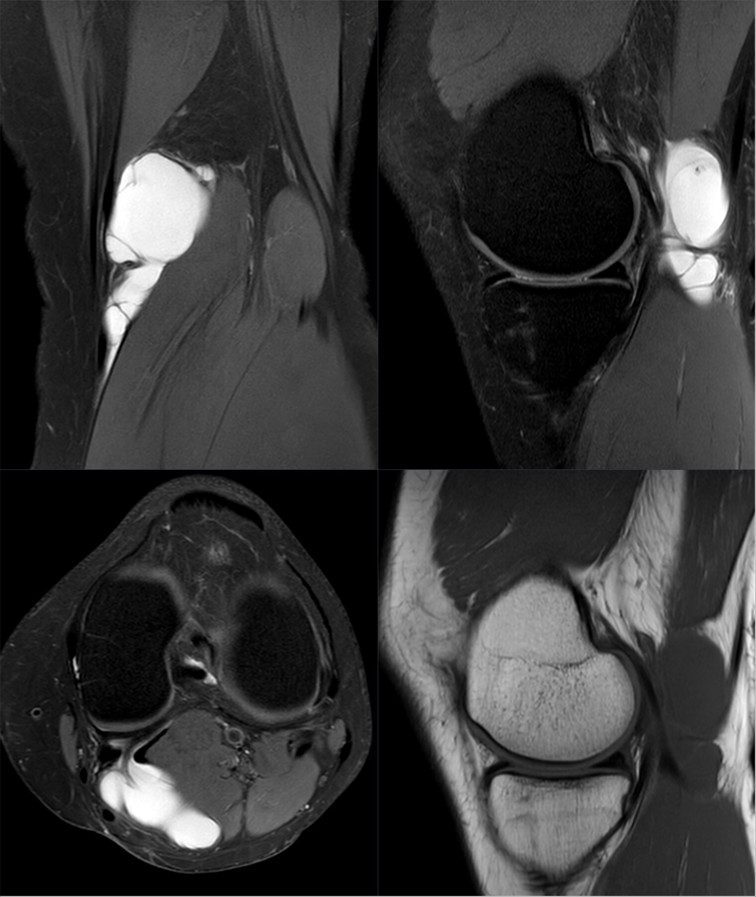 popliteal-cyst-introduction-storymd