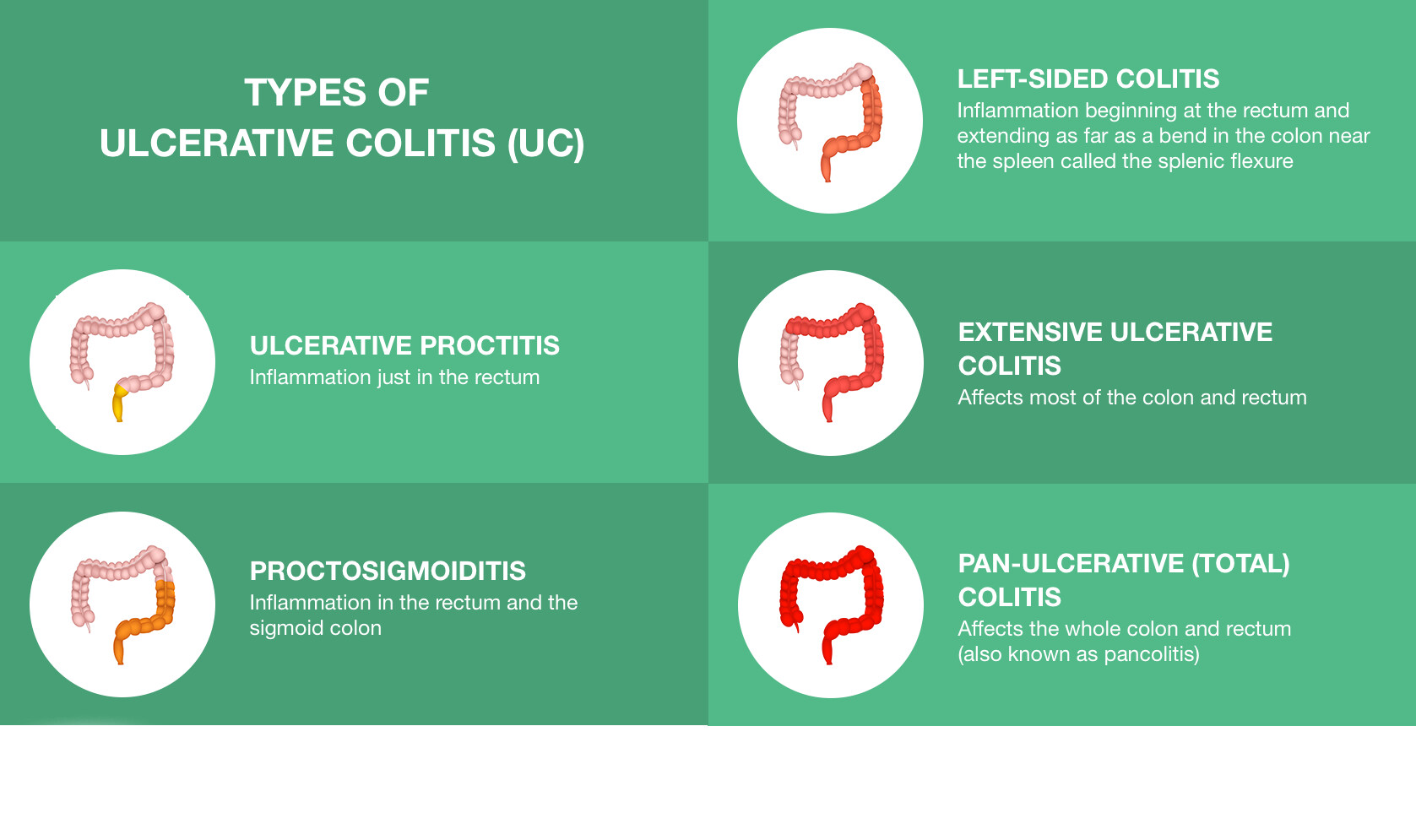 Inflammatory Bowel Disease (IBD): Types, Symptoms, Treatment - StoryMD