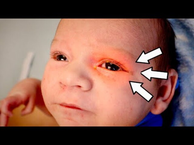 eye infection baby