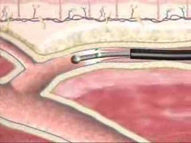 Spider veins - Mayo Clinic