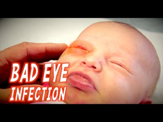 eye infection baby