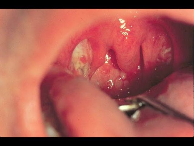 Infectious Mononucleosis (Mono) - the Kissing Disease, Animation 