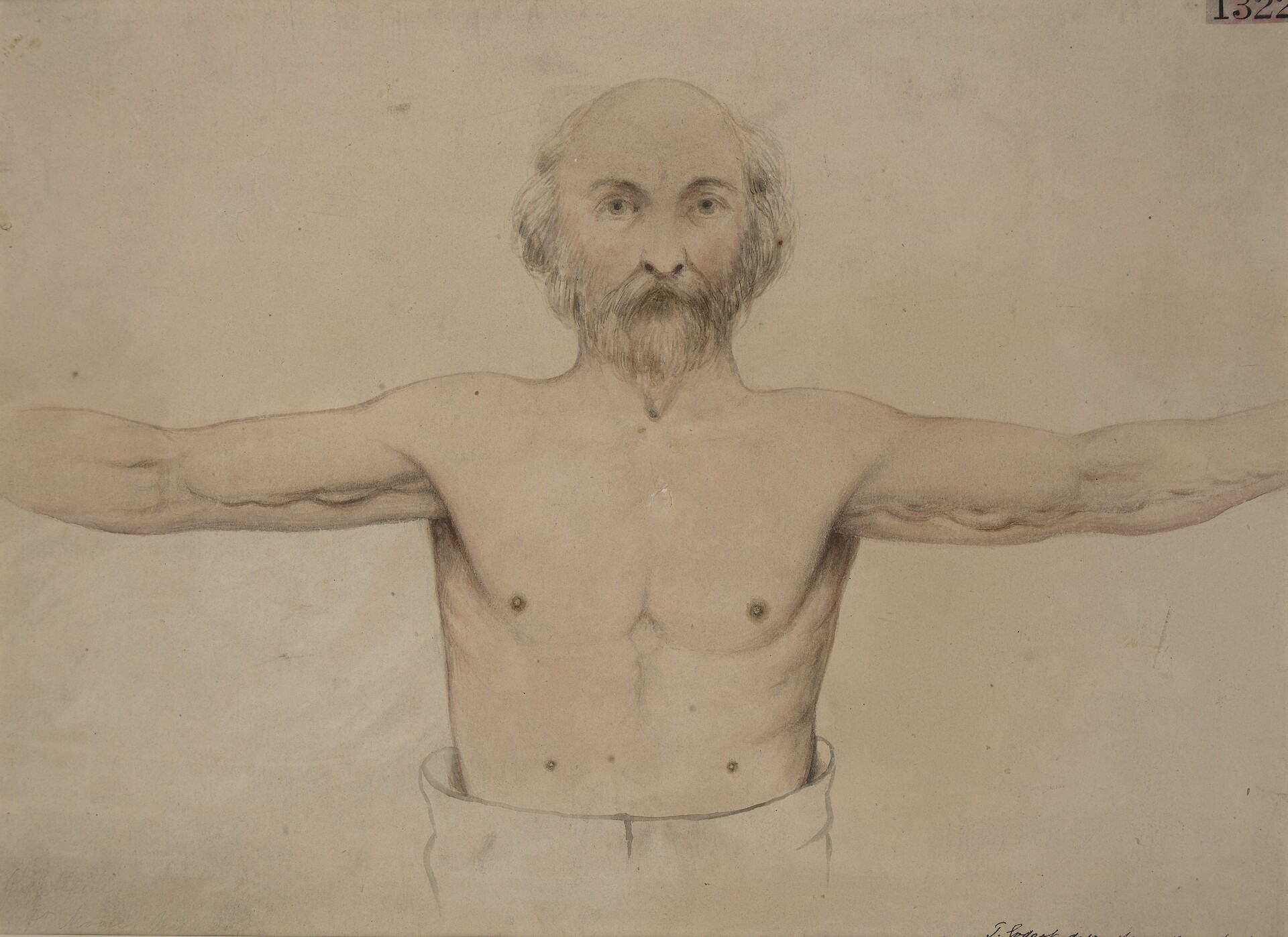 part-2-supernumerary-nipple-aka-third-nipple-explained-shorts