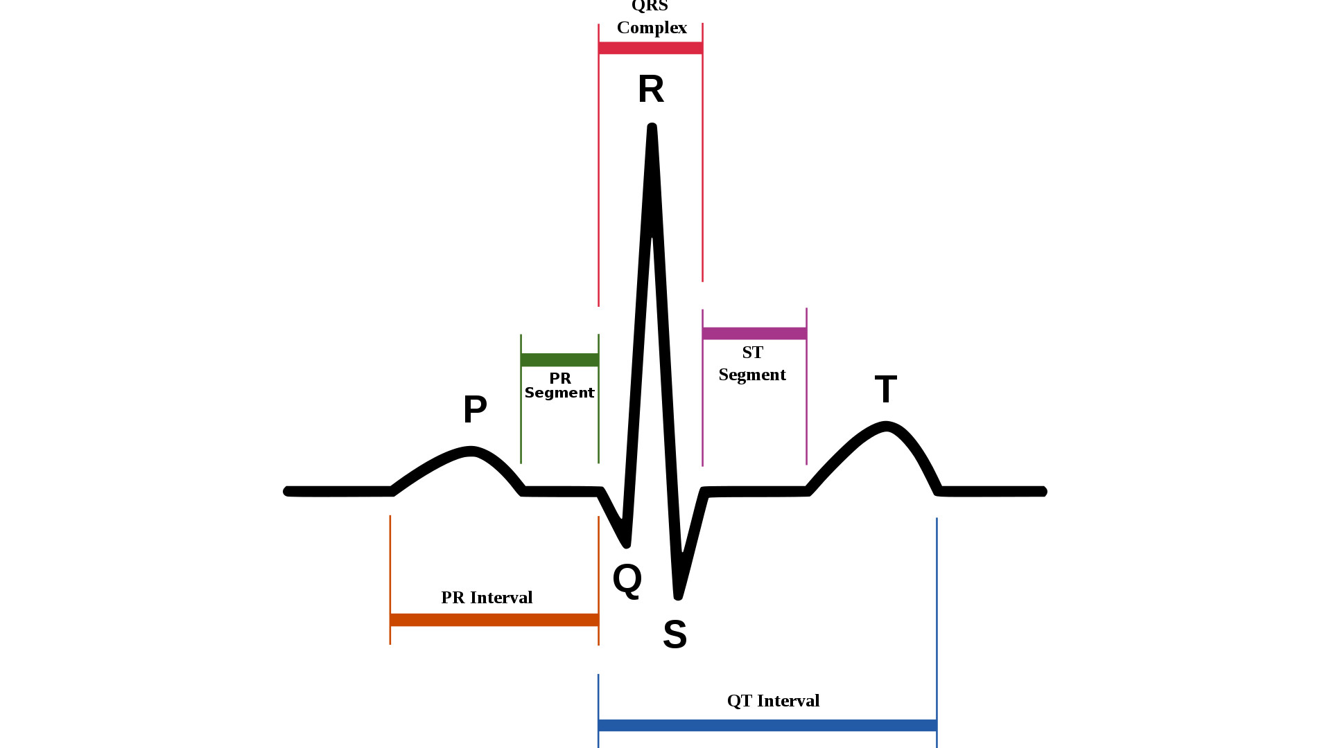 Short QT Syndrome StoryMD