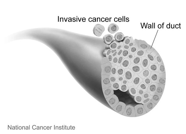 Is Invasive Ductal Carcinoma Breast Cancer