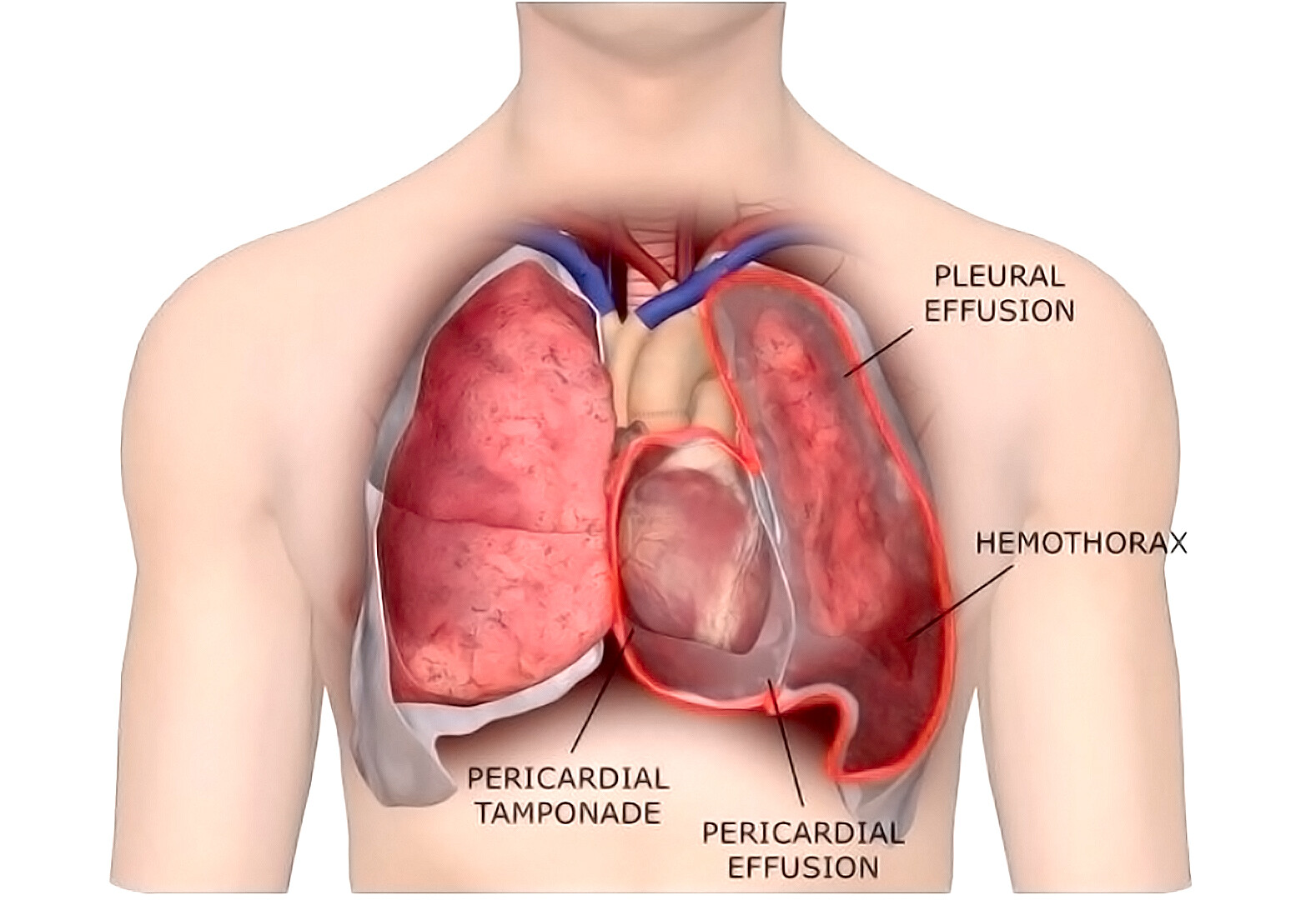 wet-wacky-lungs-what-is-pleural-effusion