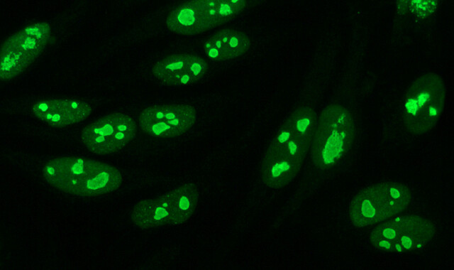ANA (Antinuclear Antibody) Test: Why Is It Done and What the Results Mean