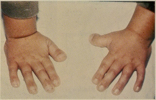 Rubinstein - Taybi Syndrome (Rubinstein syndrome, broad thumb