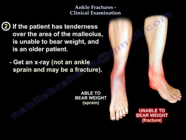 Anatomy Of The Foot & Ankle - Everything You Need To Know - Dr. Nabil  Ebraheim 