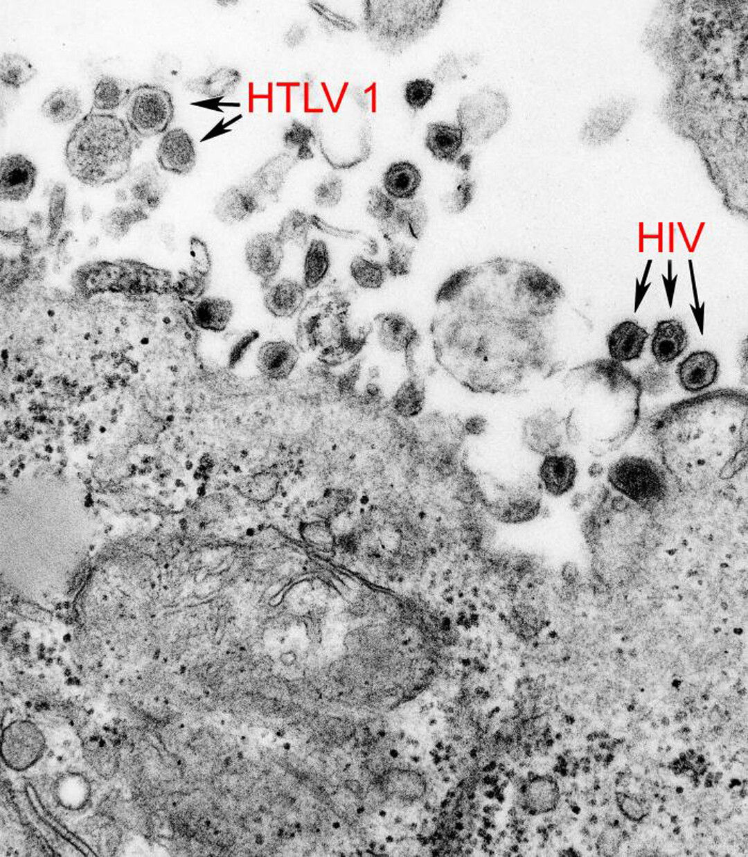 Human T Cell Leukemia Lymphoma Virus Type 1 HTLV 1 And Cancer StoryMD   Original 