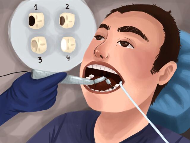 Step by Step Dental Filling (Cavity Filling - Tooth Filling): Cusp Build-Up  of a Molar 