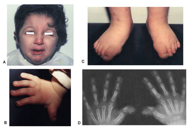 What Is Rubinstein-Taybi Syndrome? - StoryMD