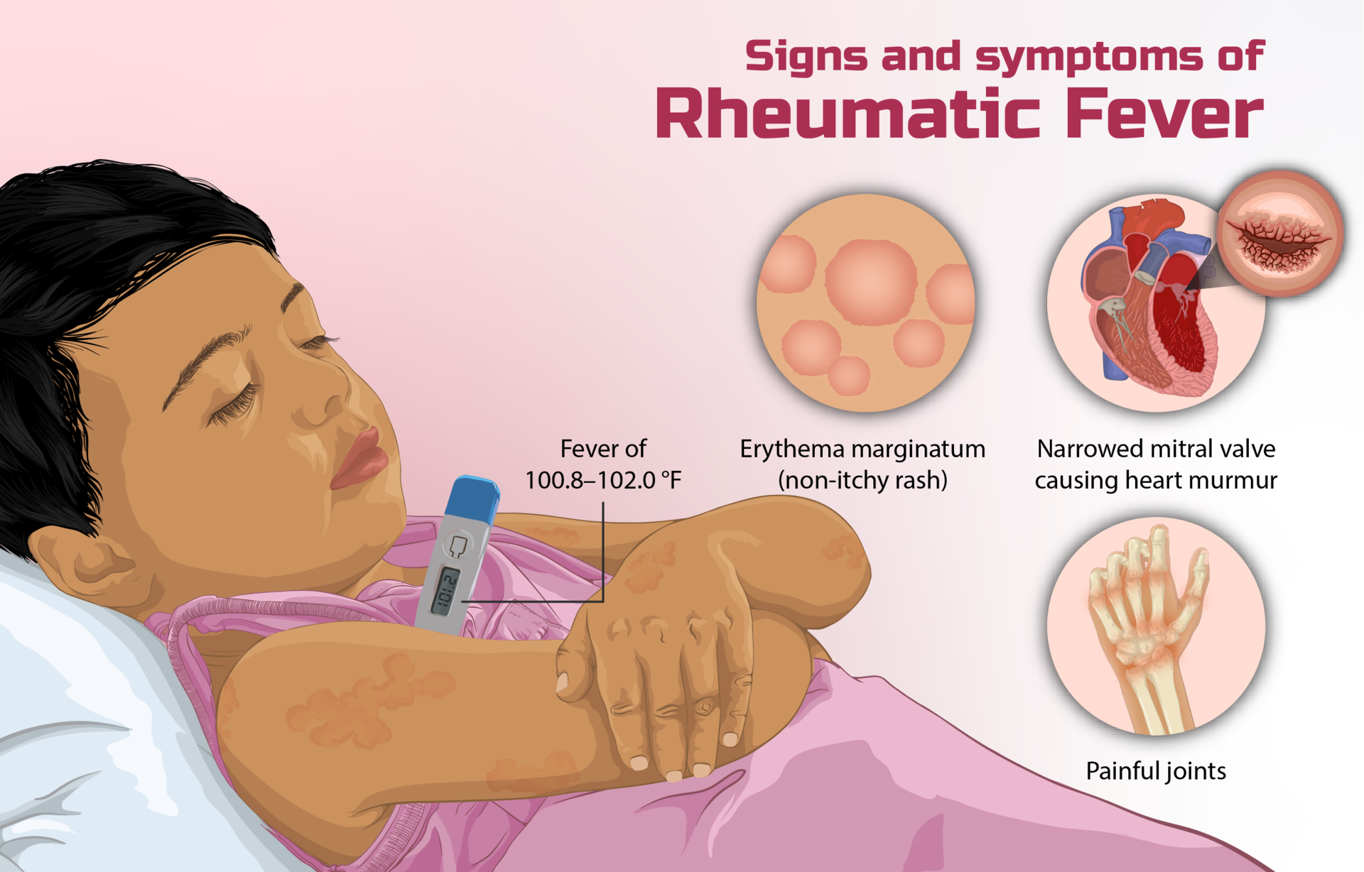 rheumatic-fever-all-you-need-to-know-storymd