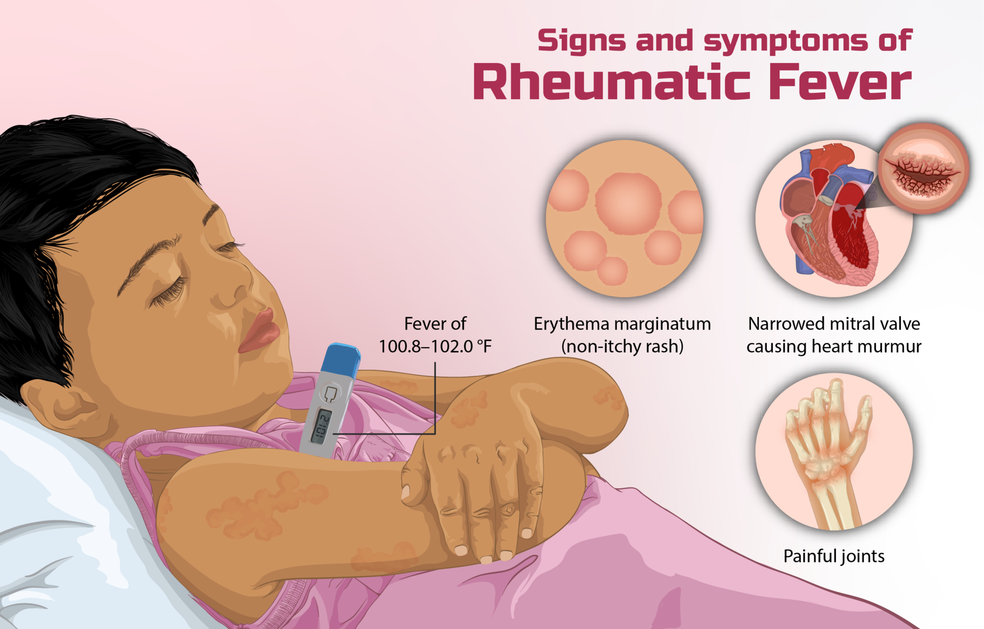 Rheumatic Fever All You Need To Know StoryMD