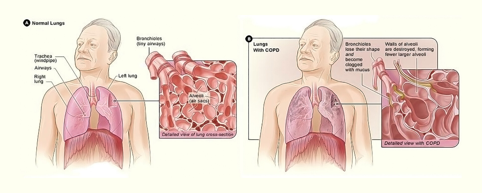 What Is a Ventilator? - StoryMD