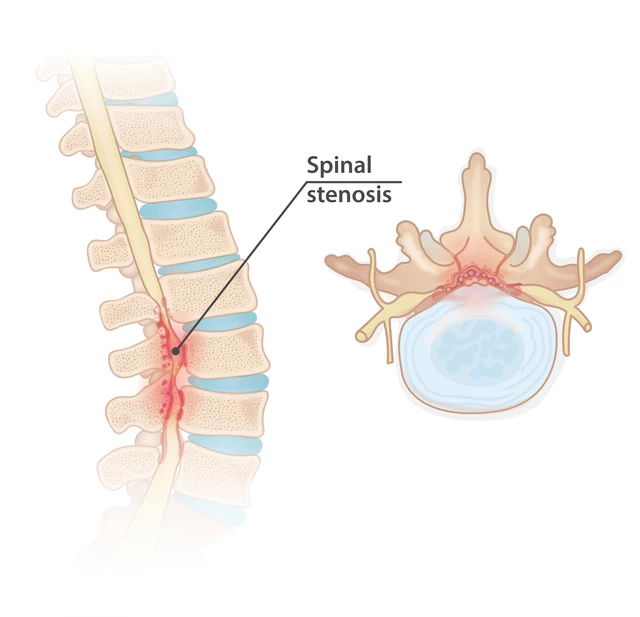 What Is Spinal Stenosis? - StoryMD
