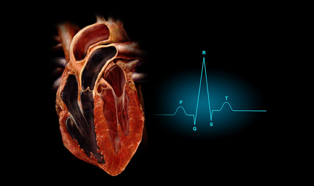 Familial Atrial Fibrillation - StoryMD