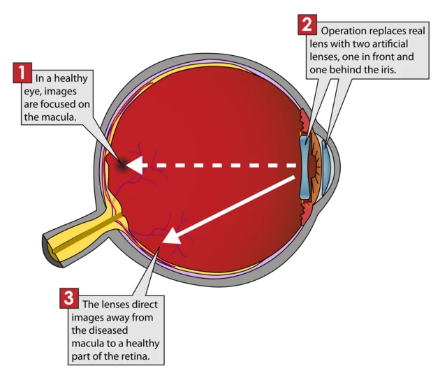 The Eye Chart - VIP Laser Eye Center