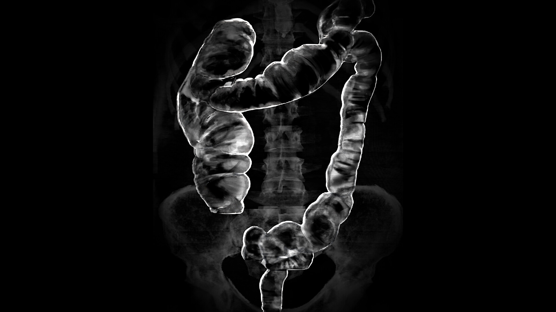 Virtual Colonoscopy Why Is It Done and What the Results Mean StoryMD