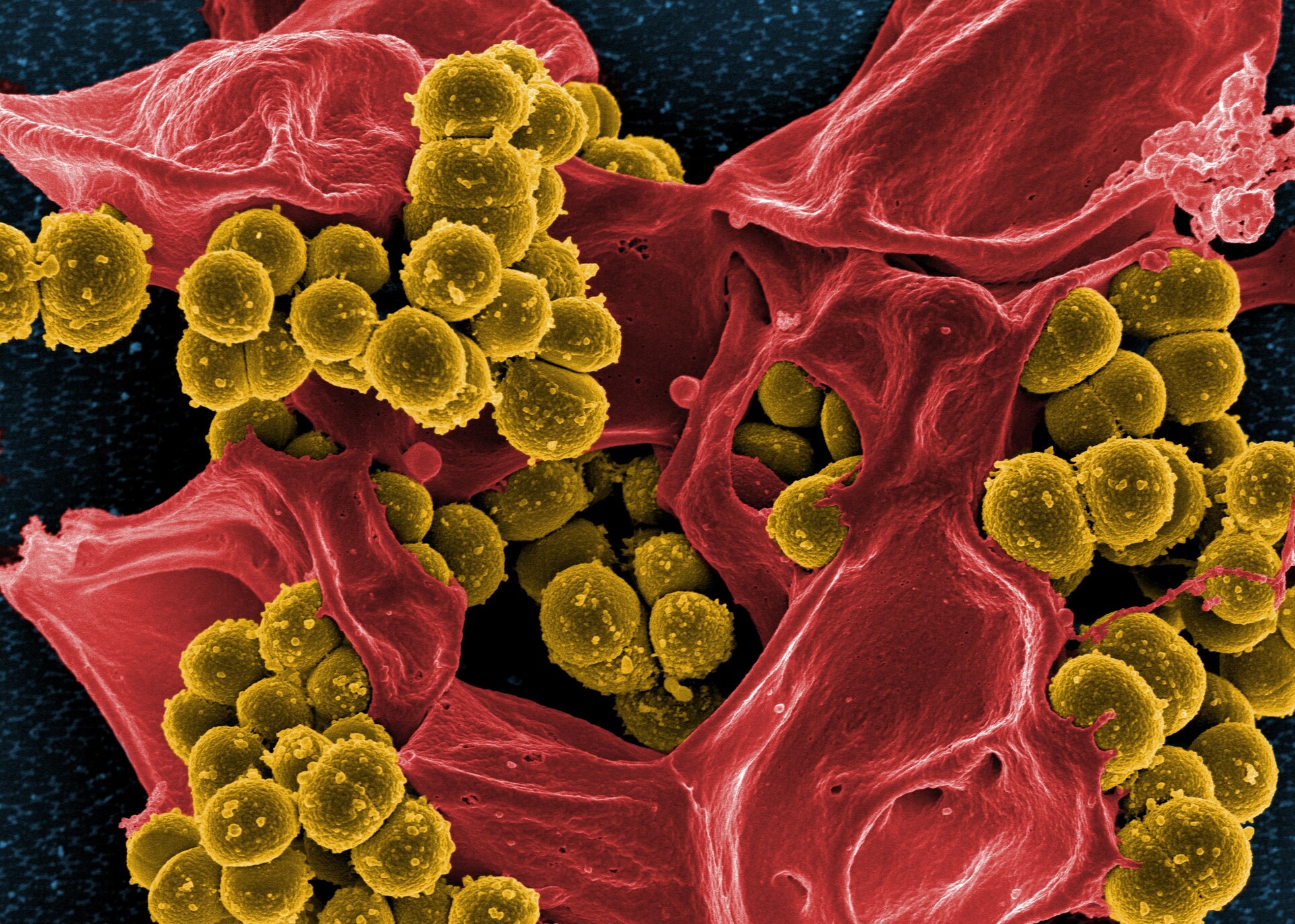 Methicillin-Resistant Staphylococcus aureus (MRSA)