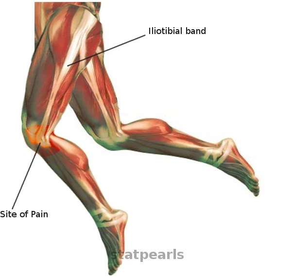 Iliotibial (ITB) band syndrome is pain that occurs due to friction of the  ITB moving over the lateral femoral epicondyle during exercise.